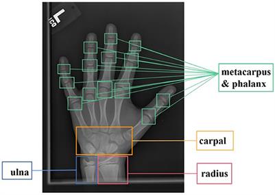 Bone age assessment based on deep neural networks with annotation-free cascaded critical bone region extraction